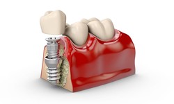 The Step-by-Step Journey: Understanding the Procedure of Single Tooth Implant