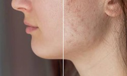 Maximizing Results: The Importance of Multiple Laser Sessions for Acne Scarring