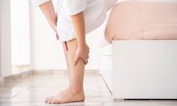 Exploring Varicose Veins and How to Manage Them