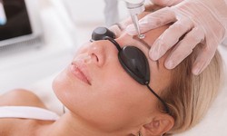 Flawless Futures: Eyebrow Laser Tattoo Removal and Self-Esteem