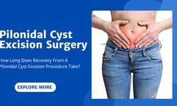 What Is The Recovery Period Following Excision of a Pilonidal Cyst?
