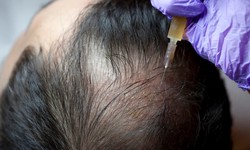 Choosing the Right Anesthesia for Your Hair Transplant