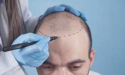 How PRP Therapy Rejuvenates Your Scalp and Hair