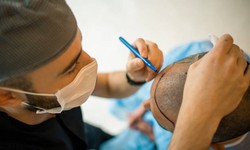 The Essential Qualities of a Hair Transplant Expert: A Comprehensive Guide