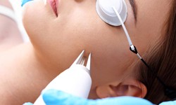 Laser Acne Scar Removal: The Art and Science