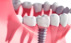 Why are dental implants the best after a certain age?