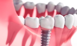 How to Choose the Right Dental Implants for You