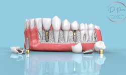 Full Mouth Dental Implants vs. Dentures: A Comprehensive Comparison (DOCTORPREM)