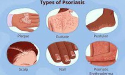 Psoriasis: A Comprehensive Guide