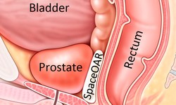 Prostate Gland Treatment - Pflow