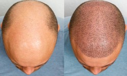 Follicle Refreshment Process: Hair Restoration