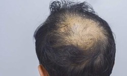 "From Thinning to Thriving: A Deep Dive into Hair Transplants"