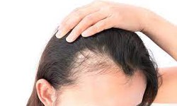 Understanding and Exploring PRP Hair Treatment for Female Pattern Baldness
