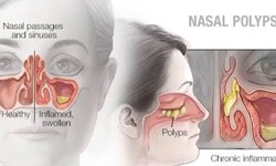 Nasal Polyps Treatment Miracle Review - Is it REALLY work for YOU?