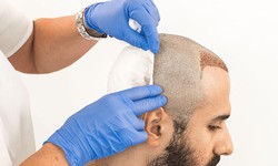 Hair Transplant Gone Wrong: Signs, Causes & Solutions