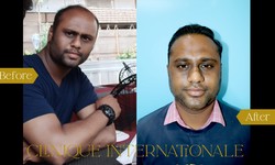 Understanding the Cost Range of Hair Transplants in Bangalore's Clinique Internationale Clinic