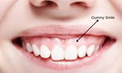 Smile with Confidence: Exploring Gummy Smile and its Treatment Options at CARA Clinic