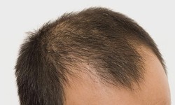 Criteria for determining eligibility for a hair transplant.