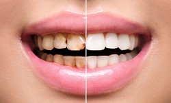 Dubai's Dental Marvels: The Benefits of Teeth Polishing & Scaling