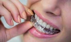 Invisalign Attachments: Austin Dentist's Secret