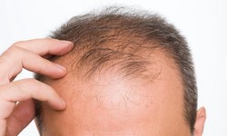 A Cost-Effective Approach to Hair Transplantation