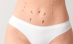Tummy Tuck in Izmir by Experienced Plastic Surgeons