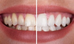 A Comprehensive Guide to Comfortable Teeth Whitening in Dubai