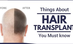 What are the steps of the hair transplant procedure and caution to be followed?