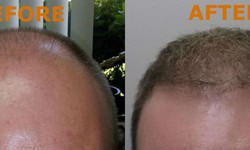 Transform Your Hairline with Neograft Hair Transplant At Toronto Cosmetic Surgery Clinic