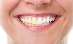 Shine On: Understanding Teeth Whitening Treatments in Dubai