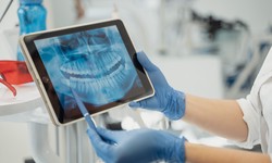 How Long Do Dental Implants Last Compared to Other Options?