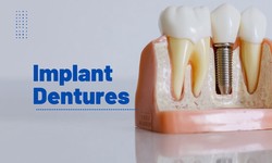 Crafting Radiant Smiles: Implant Dentures in Richmond Unleashed