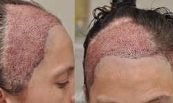 Graft Placement in Hair Transplant Treatment
