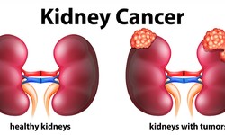Understanding Kidney Cancer: A Comprehensive Overview