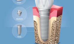 The Benefits of Dental Implants: A Comprehensive Guide