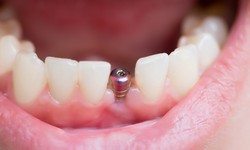 A Guide to World-Class Dental Implants in Dubai: Your Complete Walkthrough