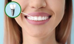 Sustaining Smiles: Dental Implants' Longevity in Dubai