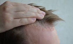 Factors Influencing the Success of a Hair Transplant