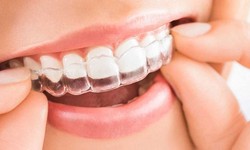 The Psychology of Invisalign: Impact on Confidence in Dubai
