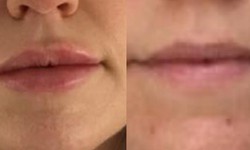 How Lip Augmentation And Lip Fillers Are Different