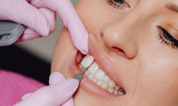 Dubai's Aesthetic Innovation: The Power of Dental Veneers