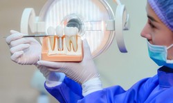 Enhancing Lives: The Impact of Modern Dental Implants