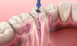 The Art of Tailored Endodontics: Root Canal Mastery