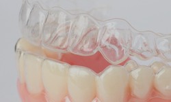Overlapping Teeth: Expert Care Options in Dubai