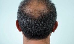 How can one maintain the health of transplanted hair in the long run?