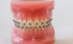 Transform Your Smile with Cutting-Edge Braces and Invisalign Technology at Redmond Orthodontics