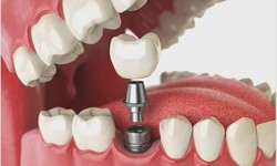 Rediscover Confidence with Dental Implants in Dubai