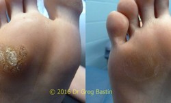 What Should I Know Before Scheduling Wart Removal in Melbourne?