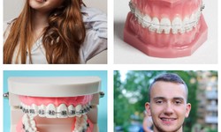 A list of some essential facts about Invisalign Aligners that you should know