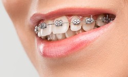 4 Compelling Reasons to Get Braces as an Adult